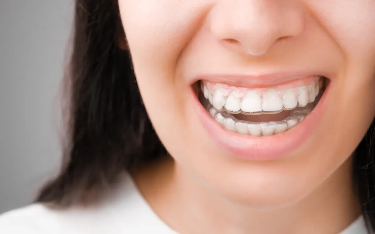 Confident smile with clear aligner